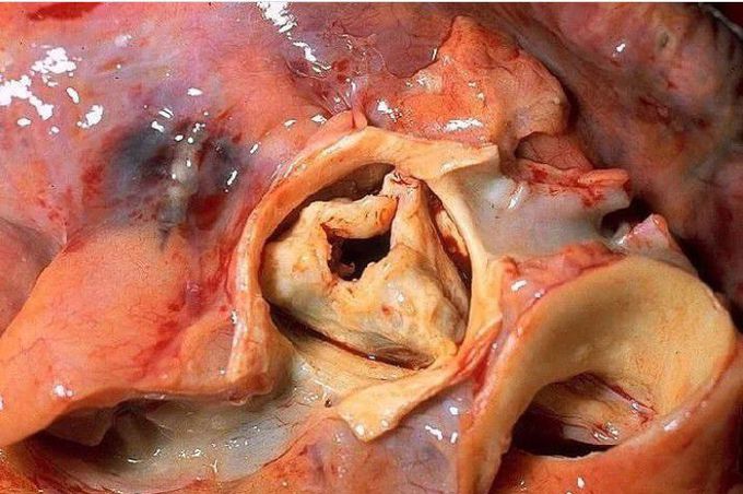 Aortic Stenosis