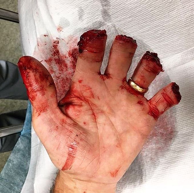 Table saw accident