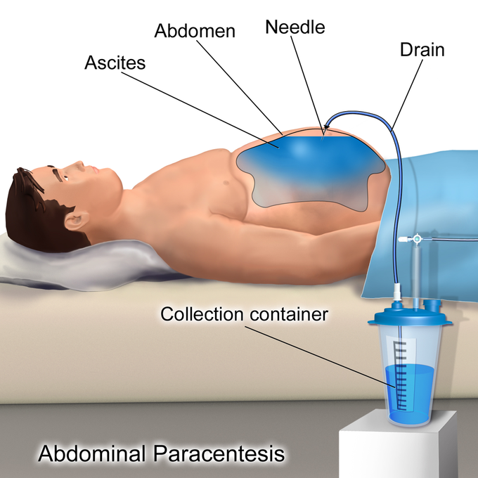 Paracentesis or Ascitic tap