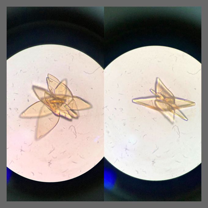 These are uric acid crystals in the microscopy of the urinary sediment. In physiological cases, uric acid crystals may appear after eating meals and strong sweat. In pathological cases, these crystals are observed when exposed to leukosis, pneumonia, and X-rays. At the same time the formation of ammonia which ensures the acid reaction of the urine is disrupted. And that's why we can see the uric crystals in the microscopy.