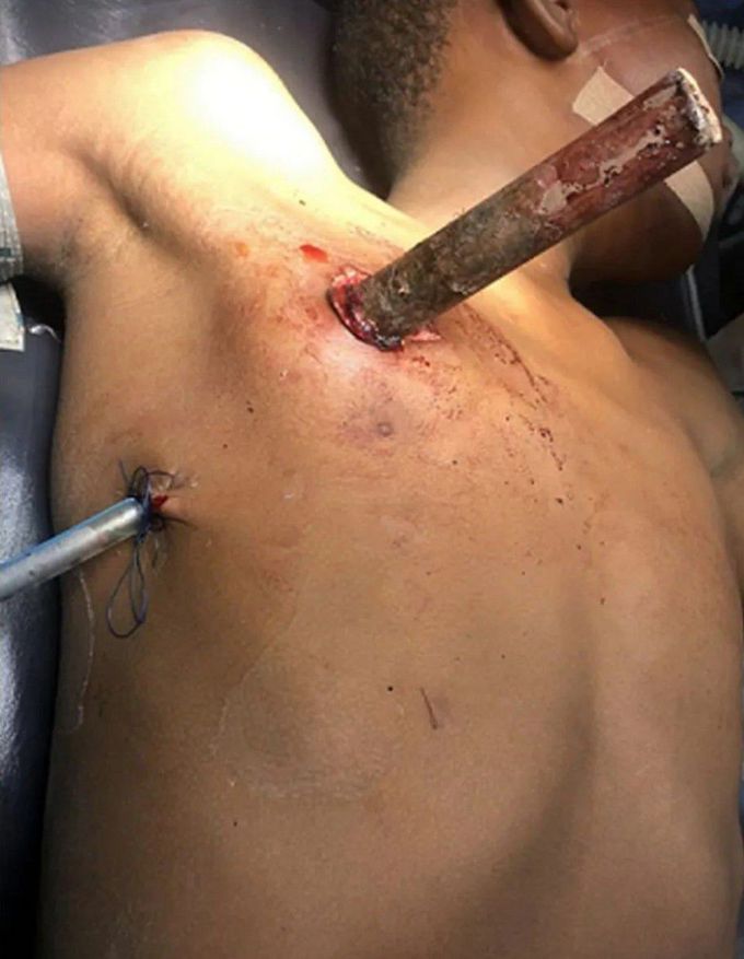 A 15-year-old cattle herder experienced an unfortunate incident while attempting to discharge a locally crafted rifle. The rifle's barrel unexpectedly recoiled backward, causing it to pierce his chest.