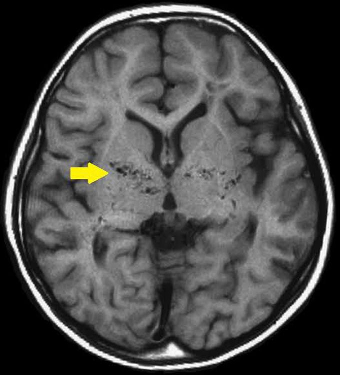 Moyamoya disease