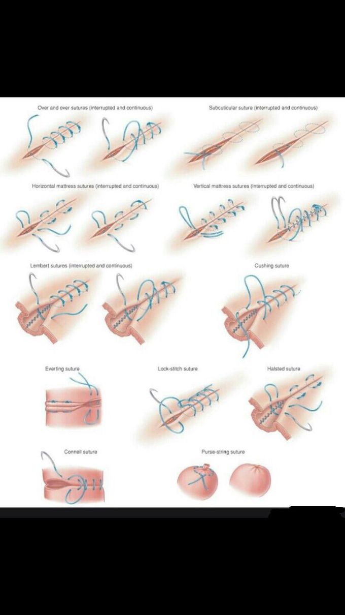 Types deals of sutures