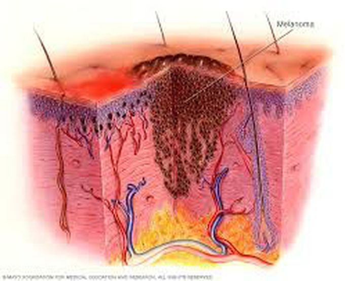 Causes of melanoma