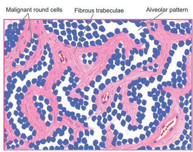 Alveolar rhabdomyosarcoma