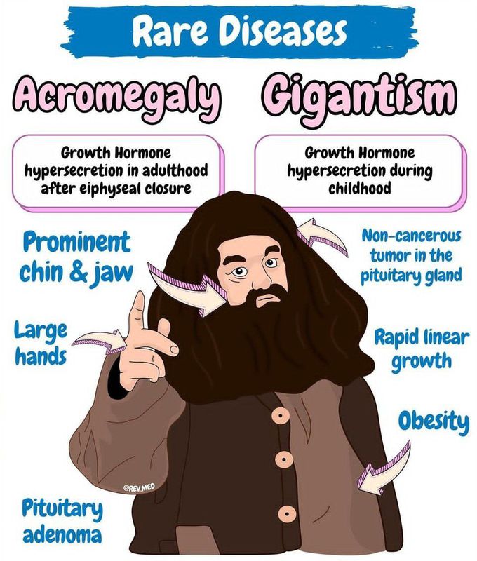 Acromegaly Vs Giagantism