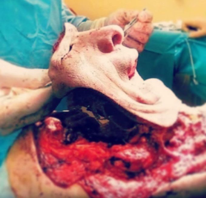 Face transplantation 