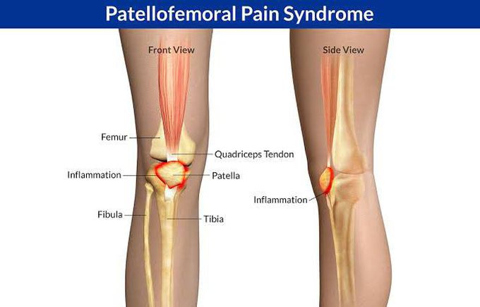 Patellofemoral Pain syndrome
