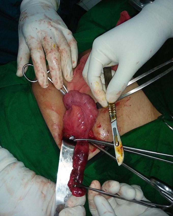 Appendectomy