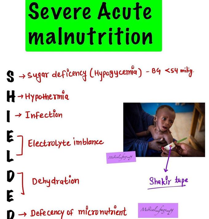 Severe acute malnutrition medizzy