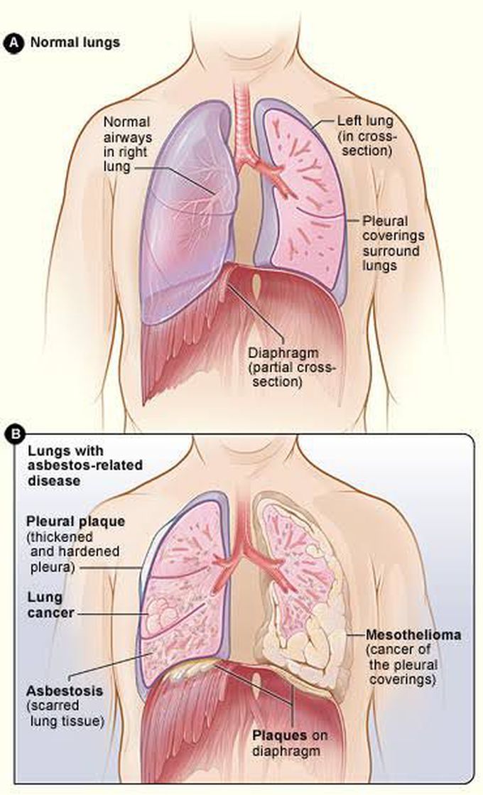 Symptoms of Asbestosis