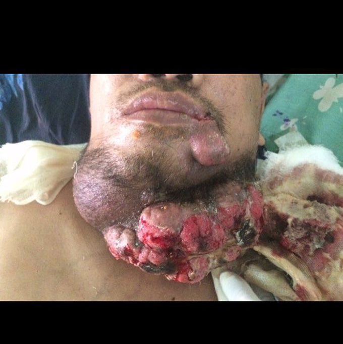 Submandibular tumor