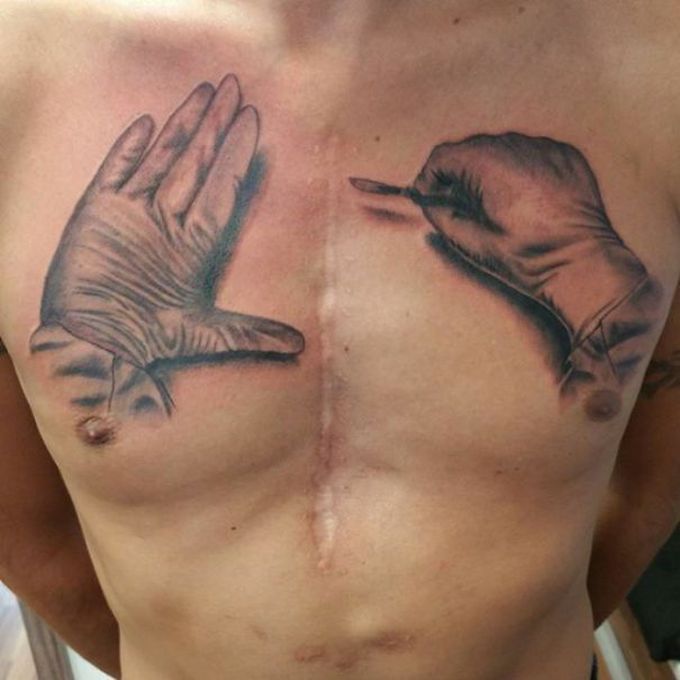 Name the different incisions you know!