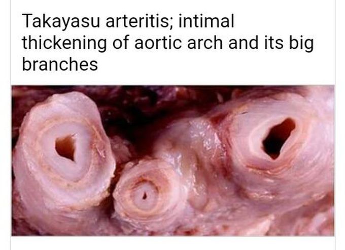 Takayasu arteries