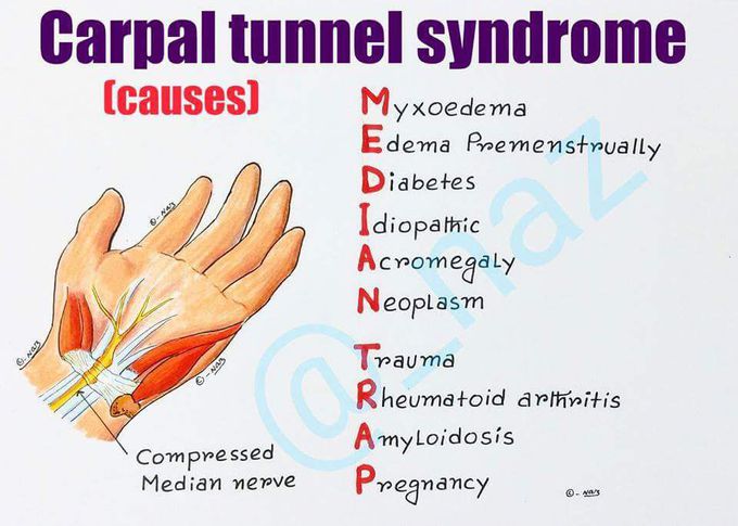 CARPAL TUNNEL SYNDROME