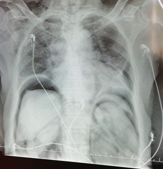 Abdomen  ,Chest xray