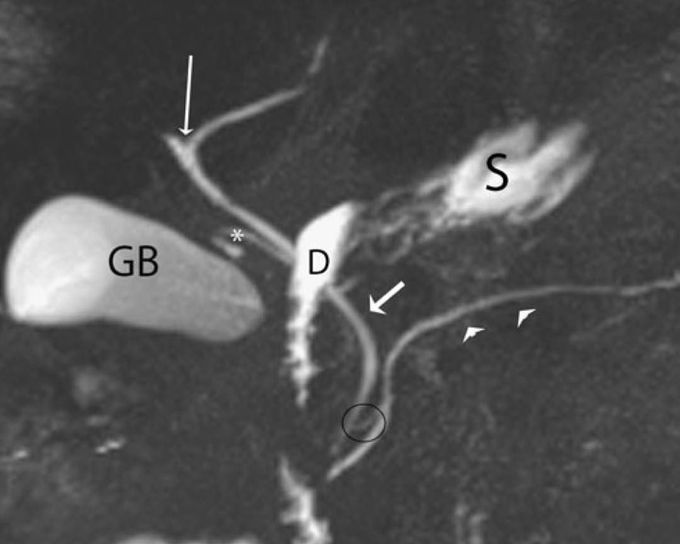 Normal anatomy on MRCP