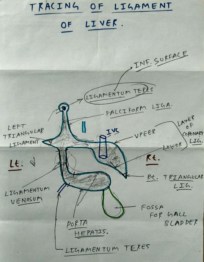Tracing of ligament of liver