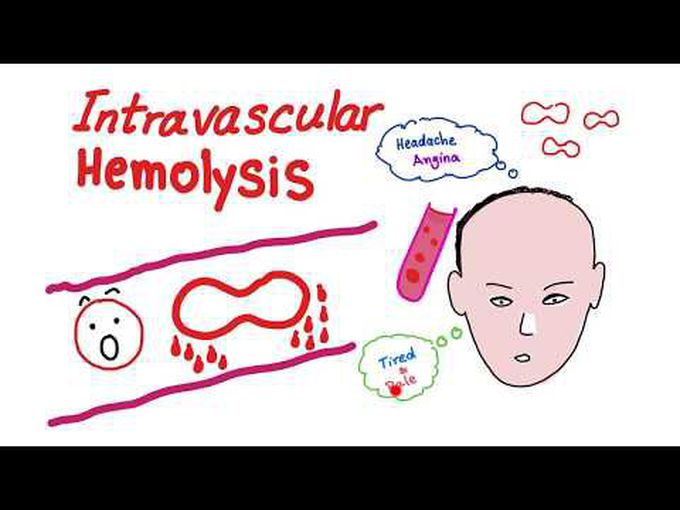 Pathology of Intravascular Hemolytic Anaemia