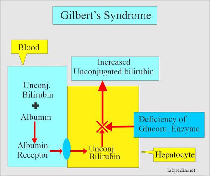 Gilbert's syndrome