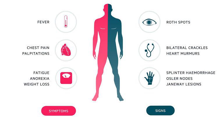 Endocarditis symptoms - MEDizzy