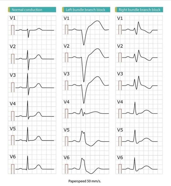 LBBB and RBBB