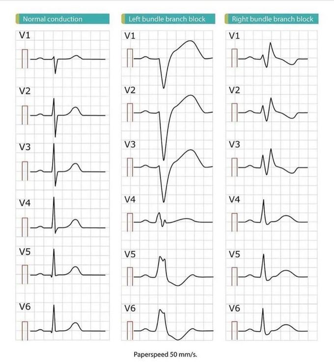 LBBB and RBBB