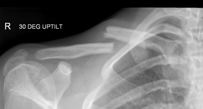 Broken Collarbone