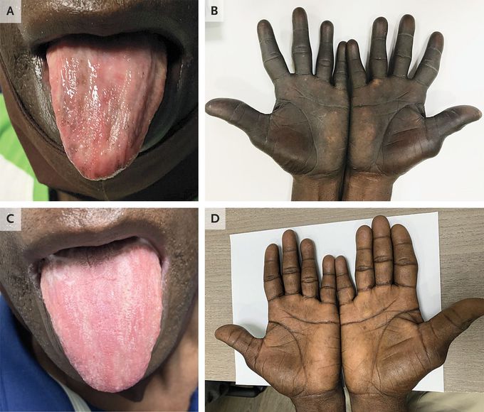 Hyperpigmentation in Vitamin B12 Deficiency