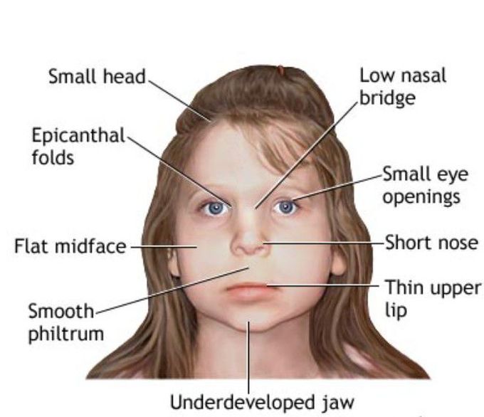 Fetal alcohol syndrome