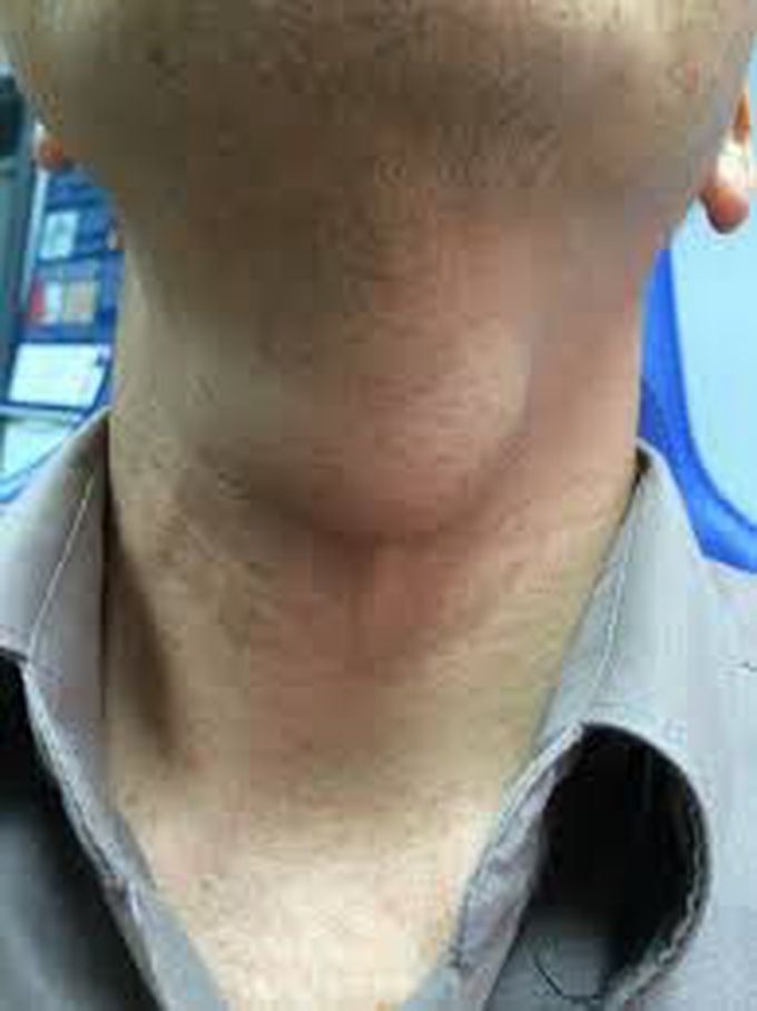 Thyroglossal duct cyst