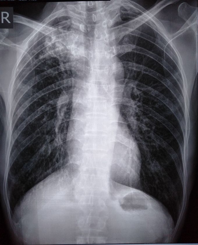 Patient 34yr come to emergency cc of hemoptysis