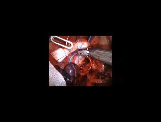 Robotic Right Upper Lobe Sleeve Lobectomy