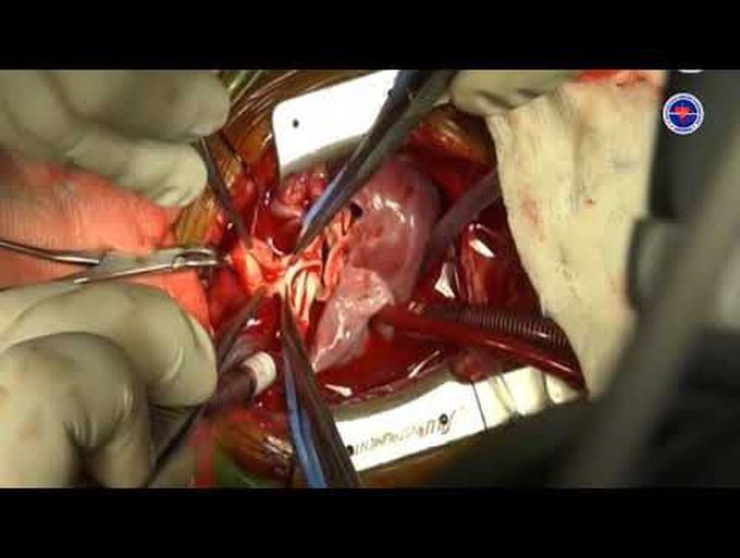 Transposition of the Great Arteries With Aortopulmonary Window: Arterial Switch Operation