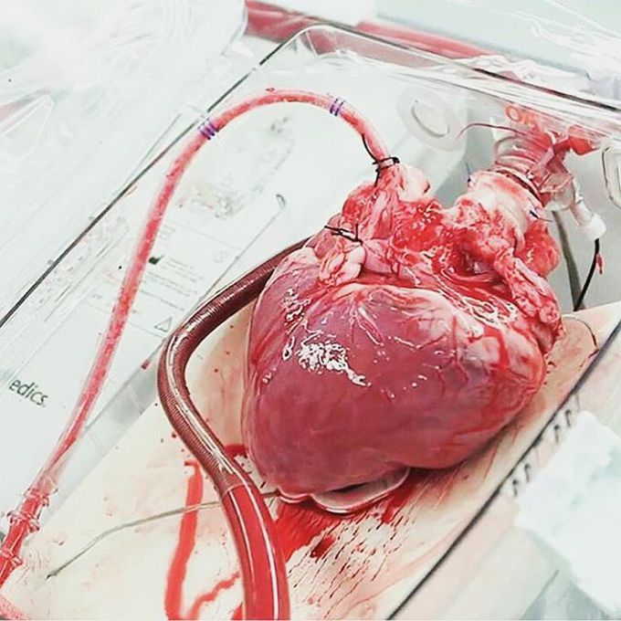 Human heart preserved to be transplanted