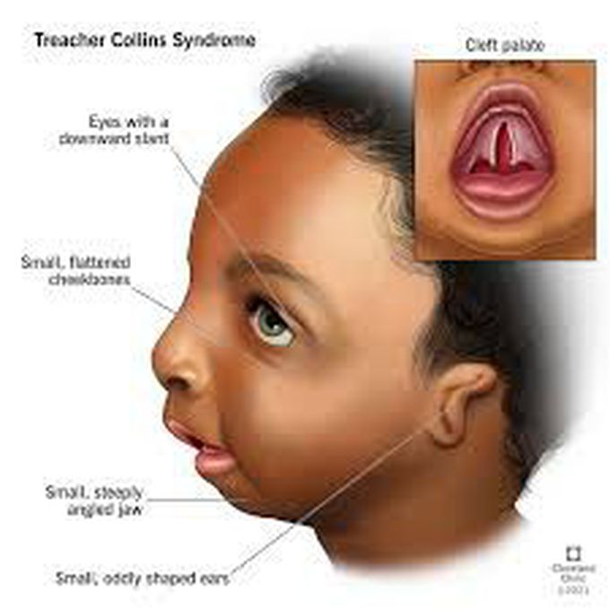Treachers collin syndrome