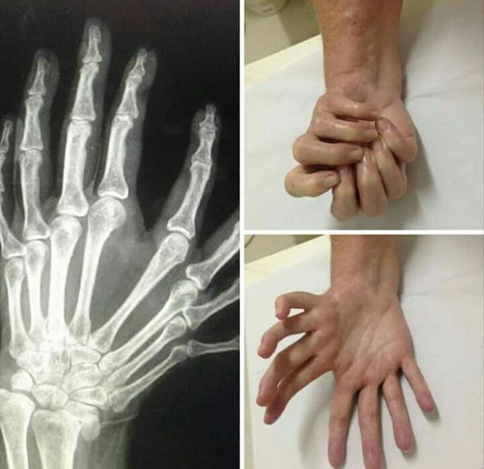 Mirror Hand Syndrome!!
