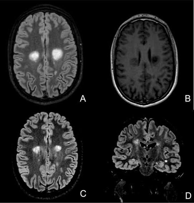 Symptoms of schilder's sclerosis