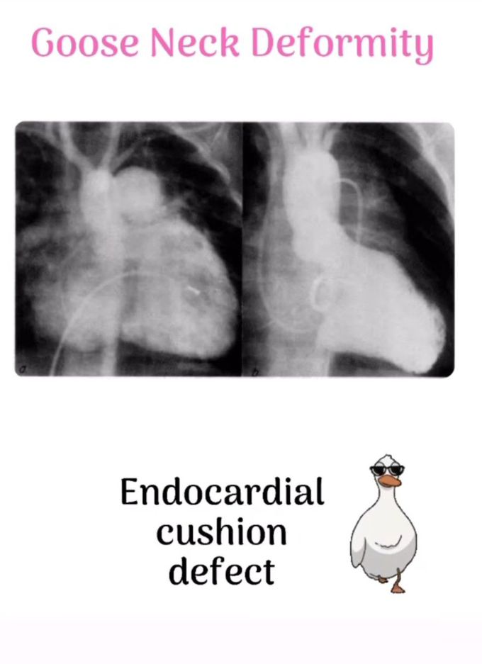 Goose Neck Deformity