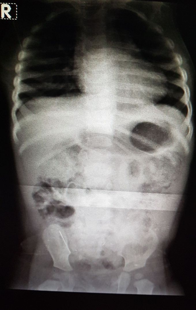 Foreign body ingestion by 11 month baby