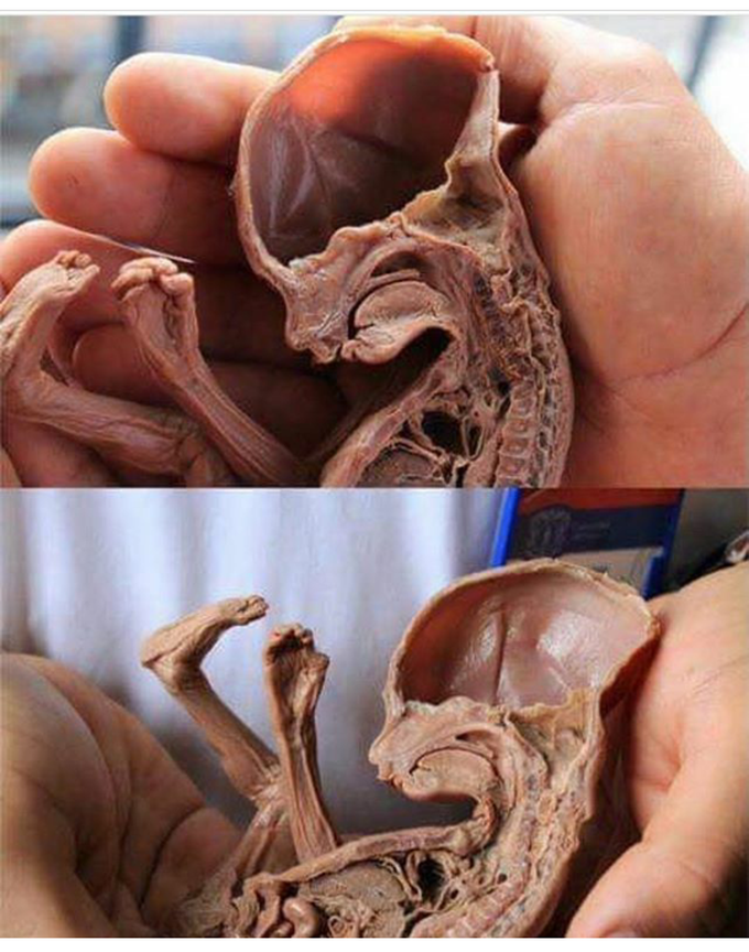 Fetus
