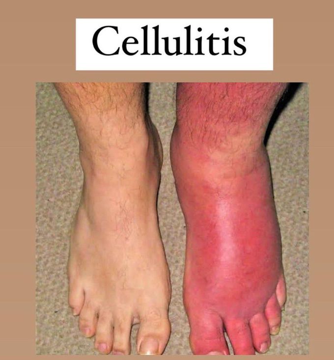 Cellulitis