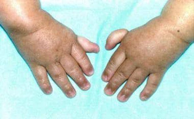 Treatment of fanconi anemia
