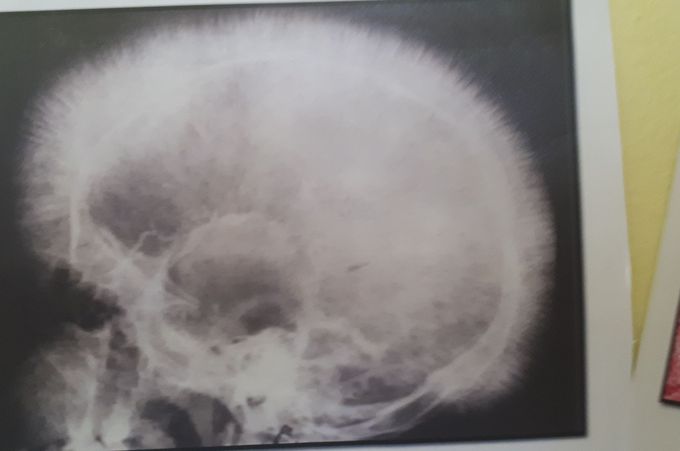 Thalassemia major skull x-ray