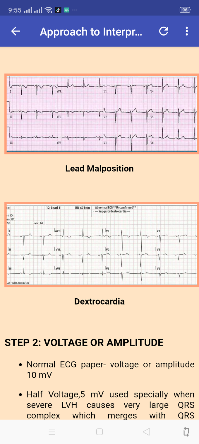 Ecg lead malpulation