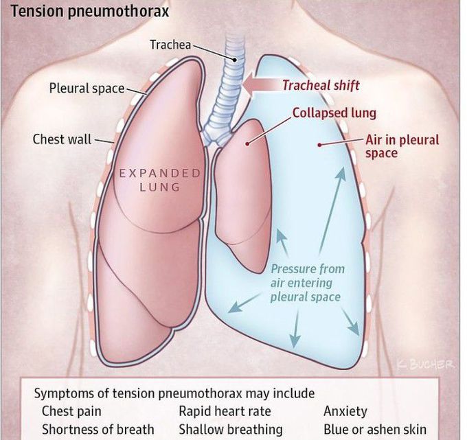 Tension pneumothorax