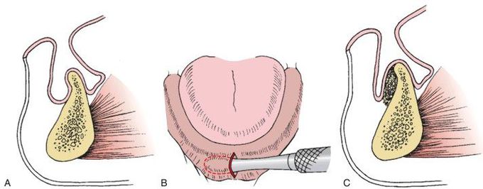 Removal of mandibular buccal undercut