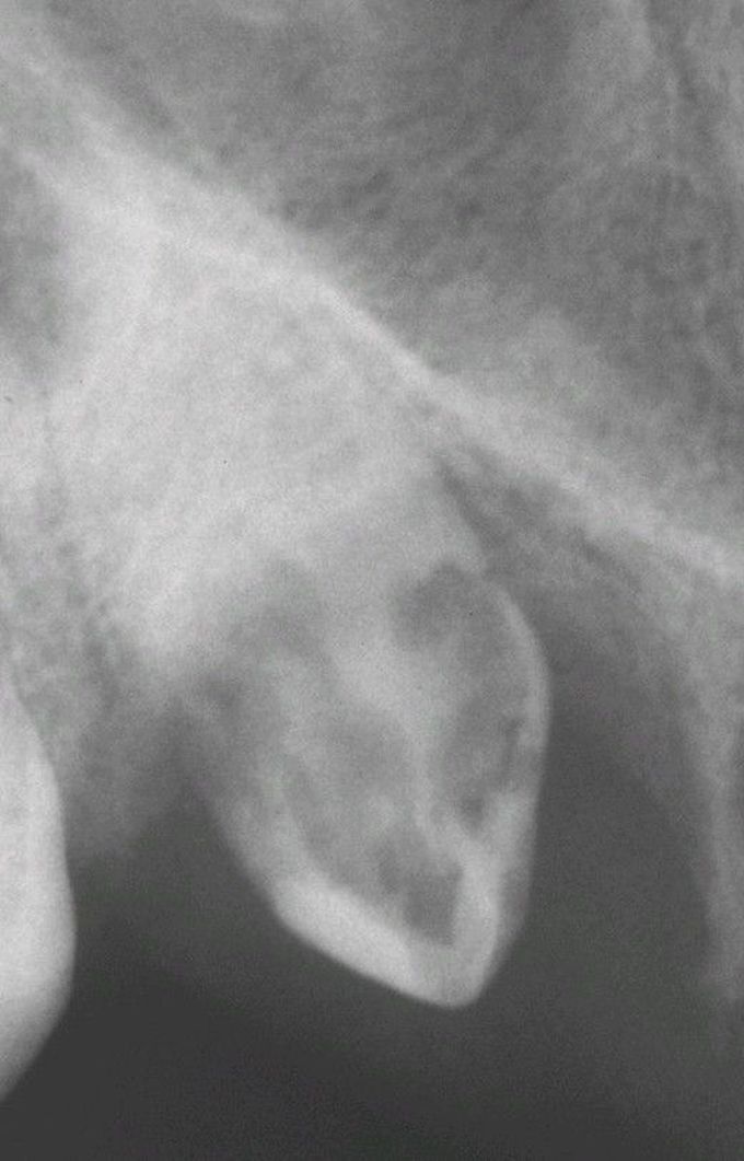 External resorption