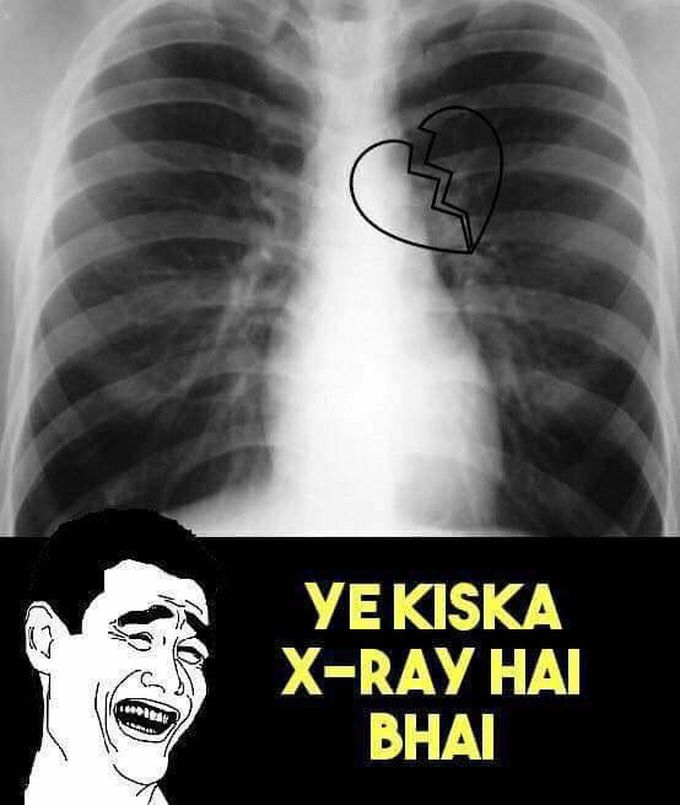X-RAY AFTER BREAKUP 😂😂