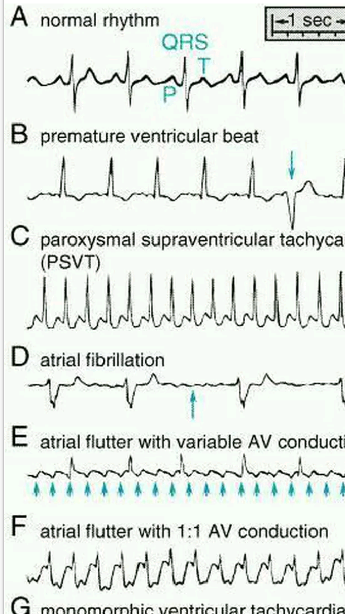 Ecg interpretation.